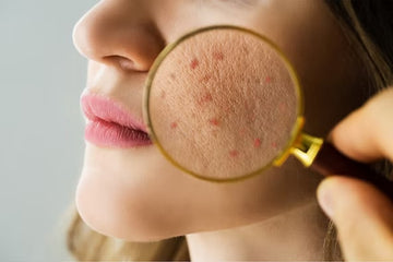 Acne Treatment Options: From Drugstore Staples to Custom Compounded Care