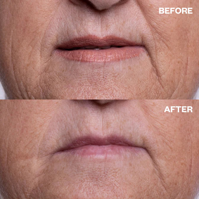 Wrinkles Schminkles Mouth & Lip Wrinkle Patch
