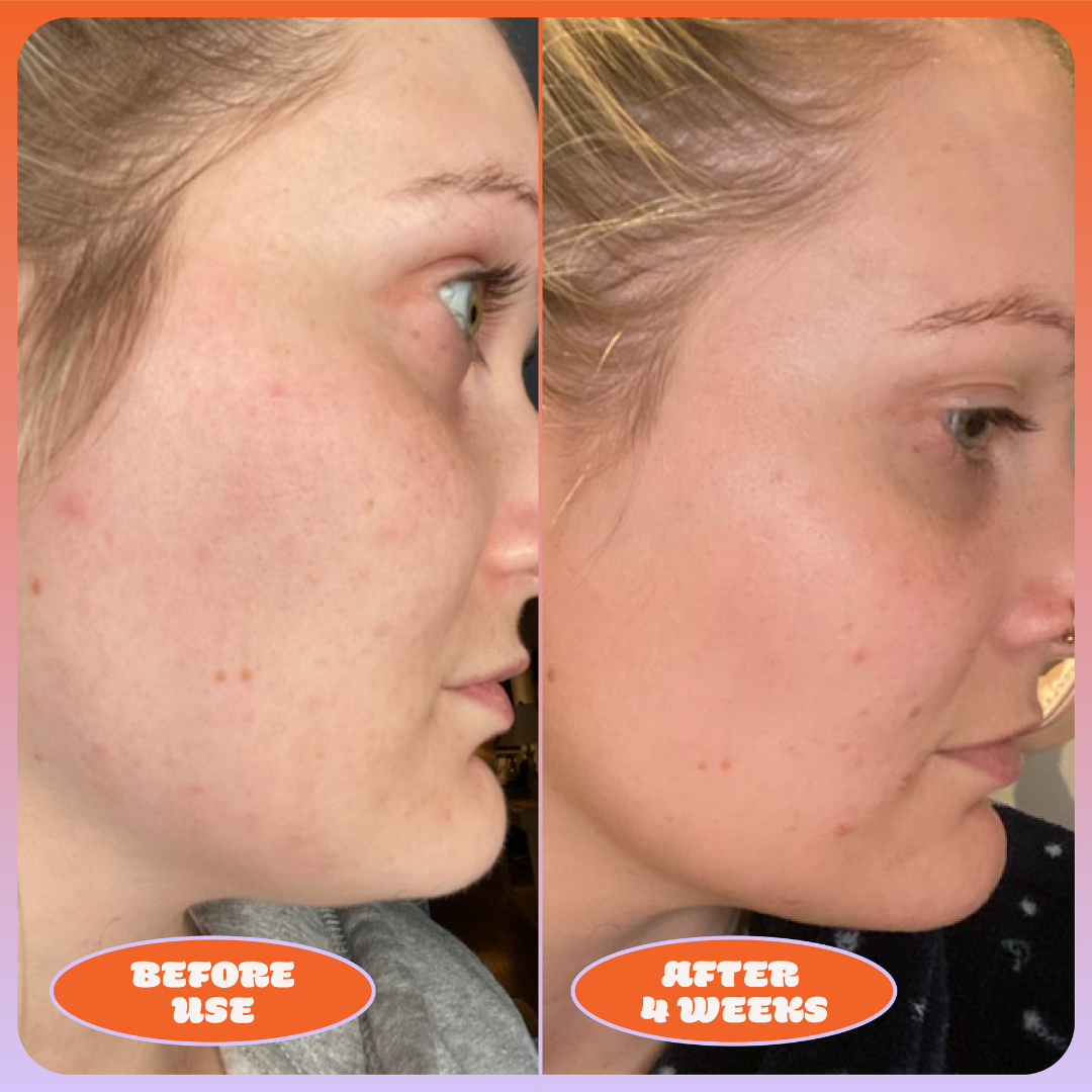 Blume Acne Treat & Fade Bundle