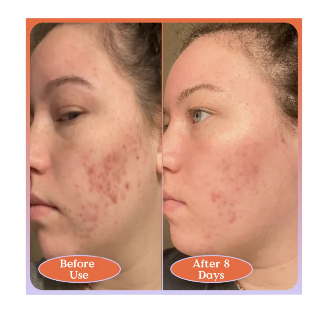 Blume Acne Treat & Fade Bundle