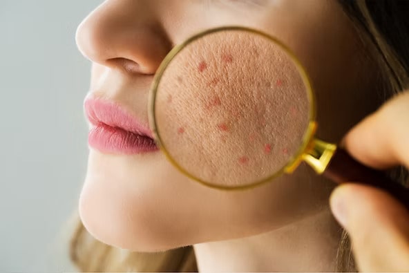 Acne Treatment Options: From Drugstore Staples to Custom Compounded Care