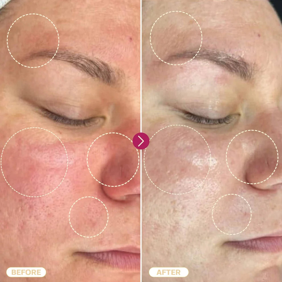 Before and after comparison of a person's face with skin issues highlighted.