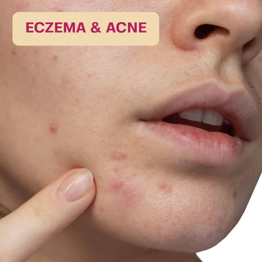 Close-up of a person's face with eczema and acne, pointing to the skin issues.
