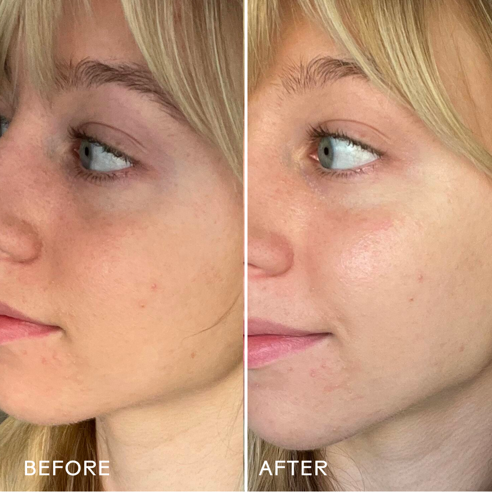 Before and after comparison of a woman's face with visible skin texture differences.