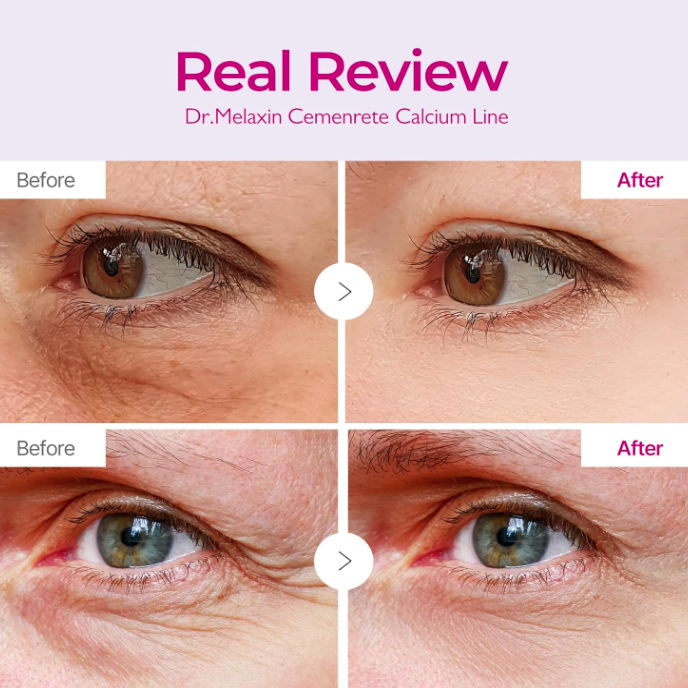 Before and after comparison of eye area with Dr. Melaxin Cemenrete Calcium Line product.