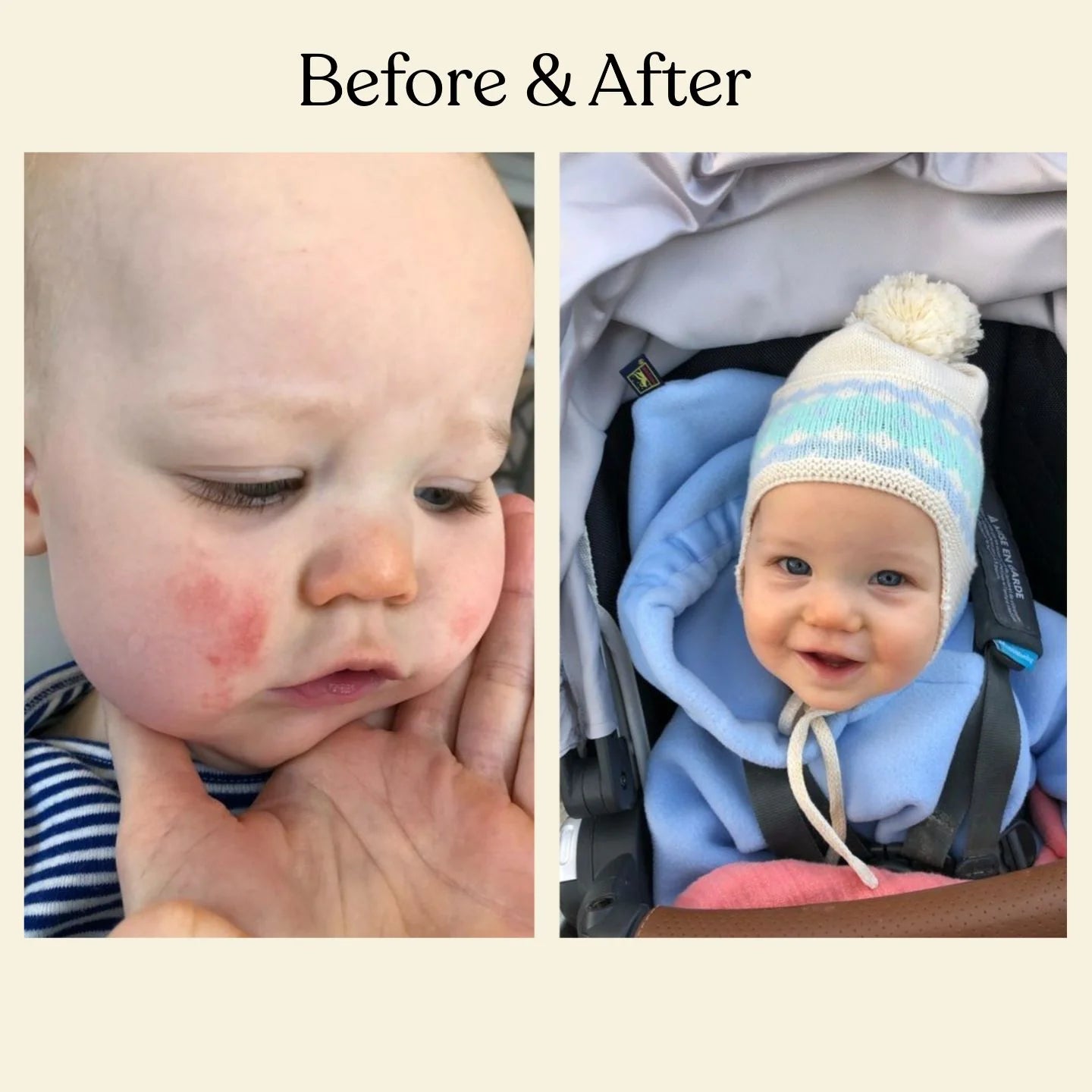 Before and after comparison of a baby with red cheeks and a happy baby in a stroller wearing a hat.
