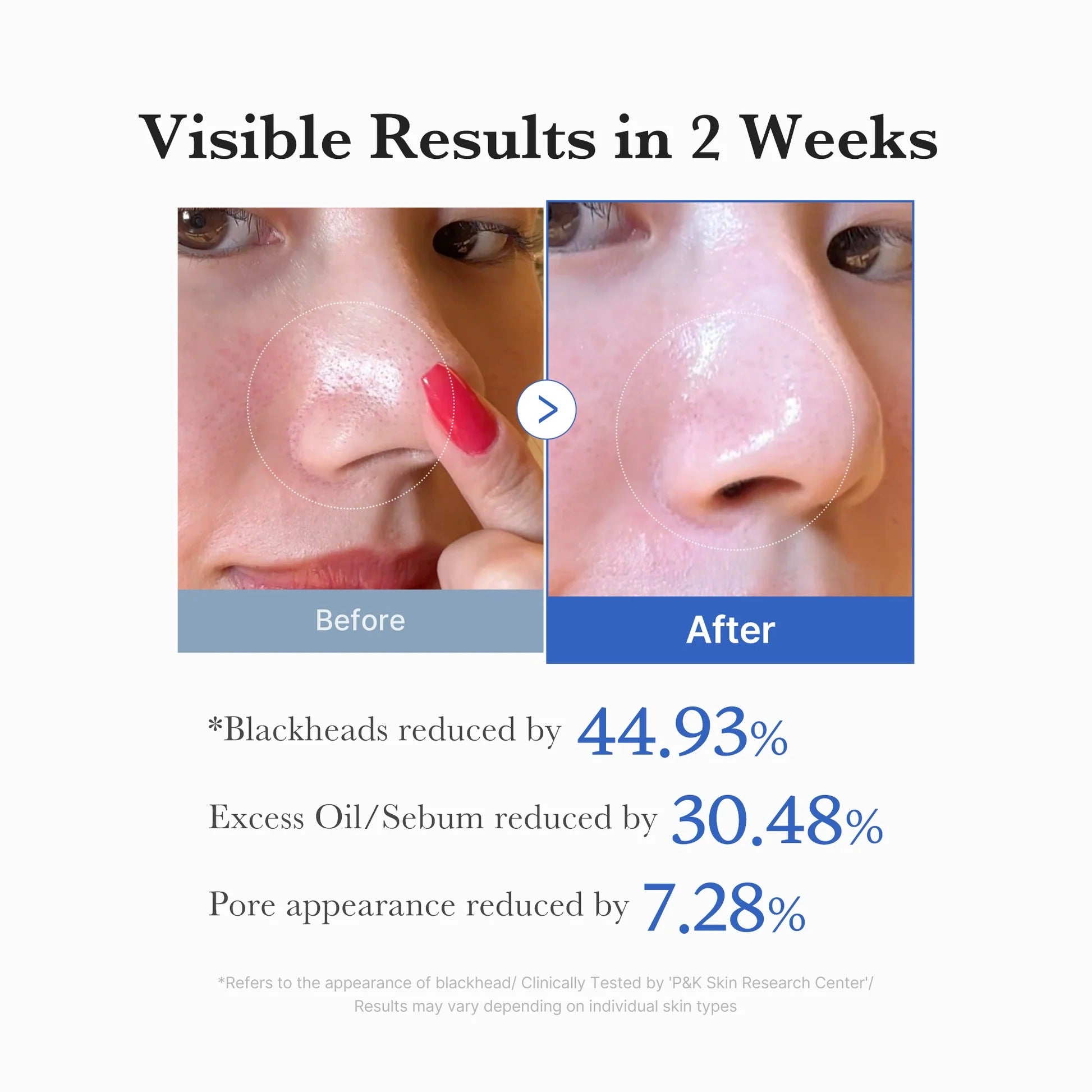 The Pharmacy Lab Medicube Zero Pore Pad 2.0 before and after results showing reduced blackheads, oil, and visible pores