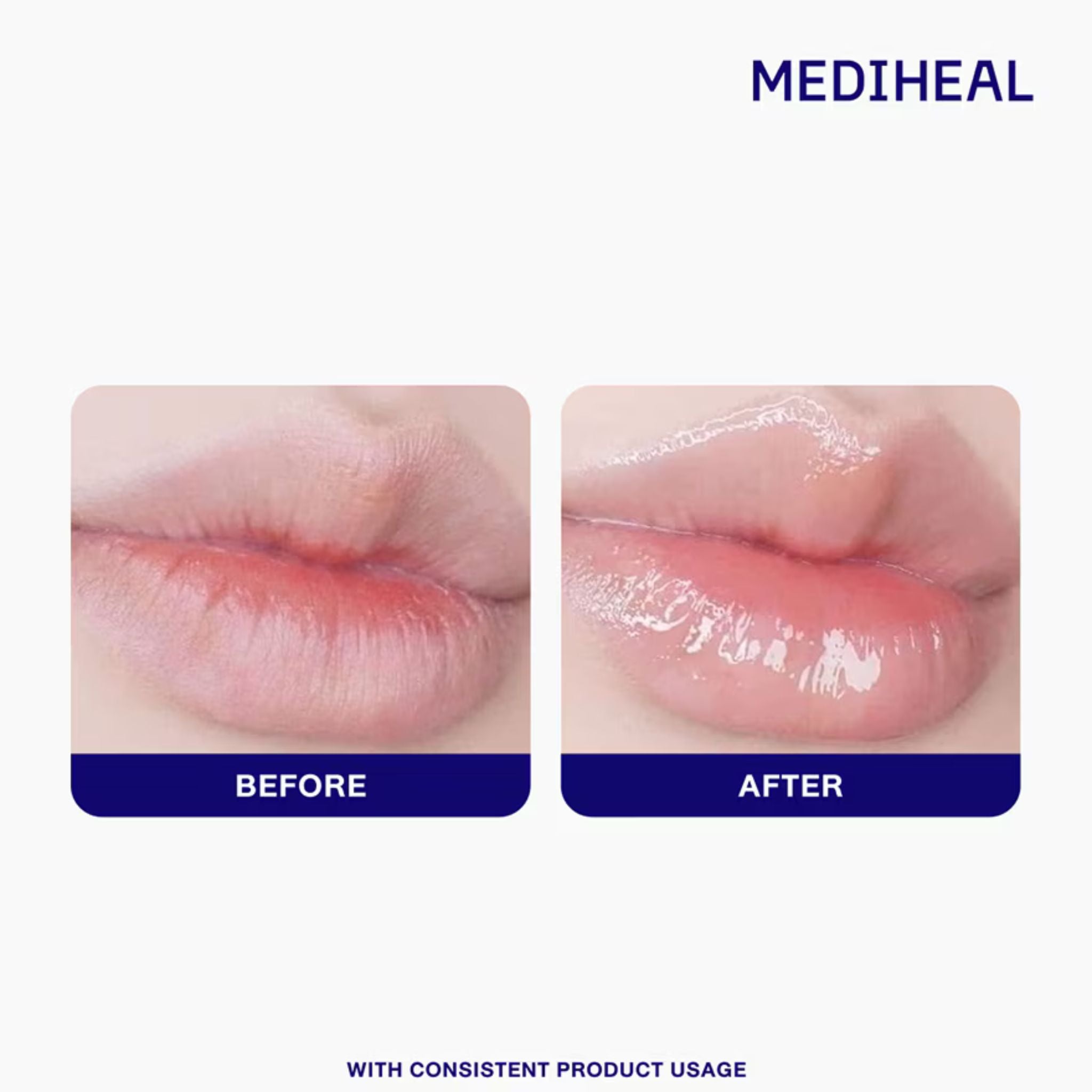 Before and after comparison of lips with Mediheal branding