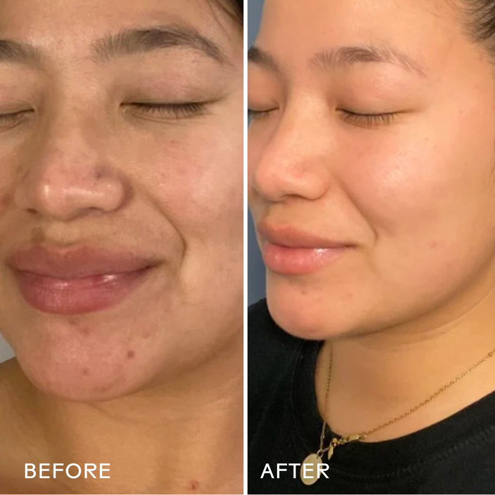 Before and after comparison of a woman's face with visible skin improvement.