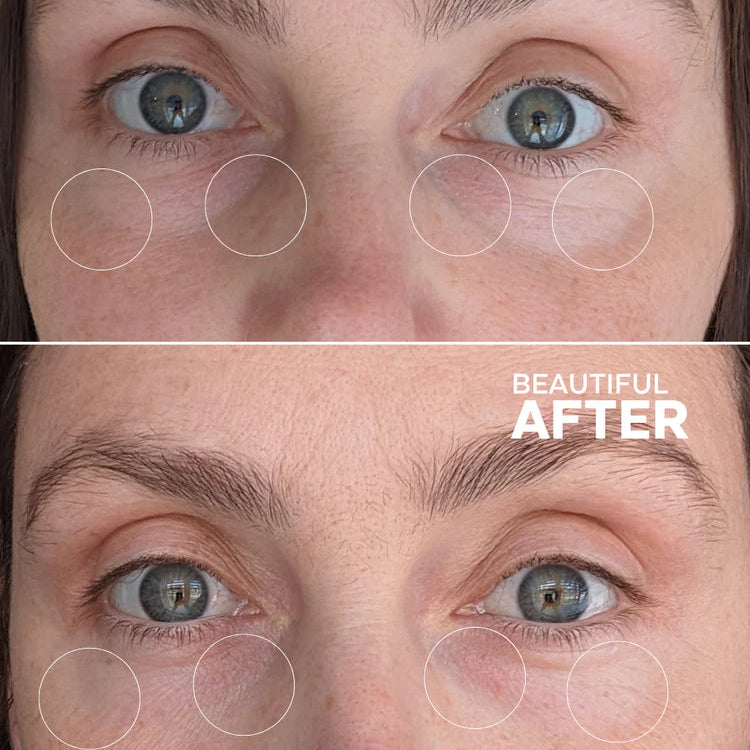 Before and after comparison of a woman's eye area with visible improvements.