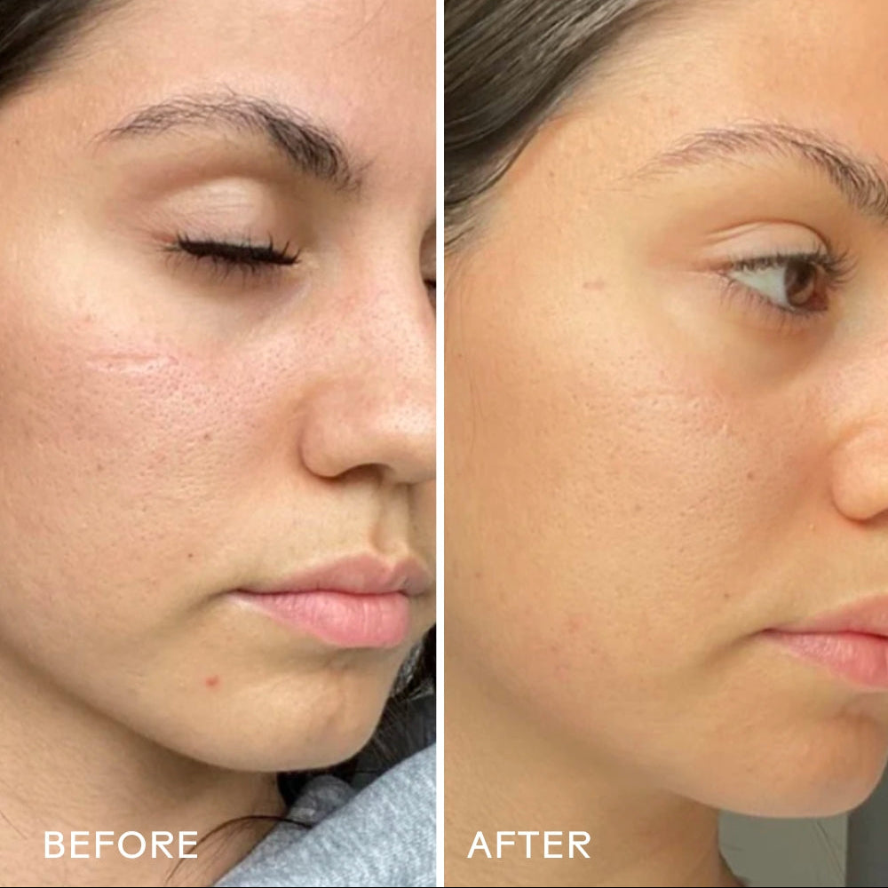 Before and after comparison of a woman's face with visible skin improvement.