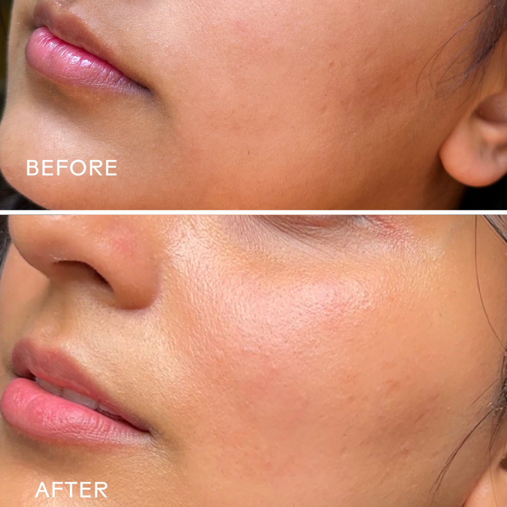 Before and after comparison of a person's face with visible skin texture changes.