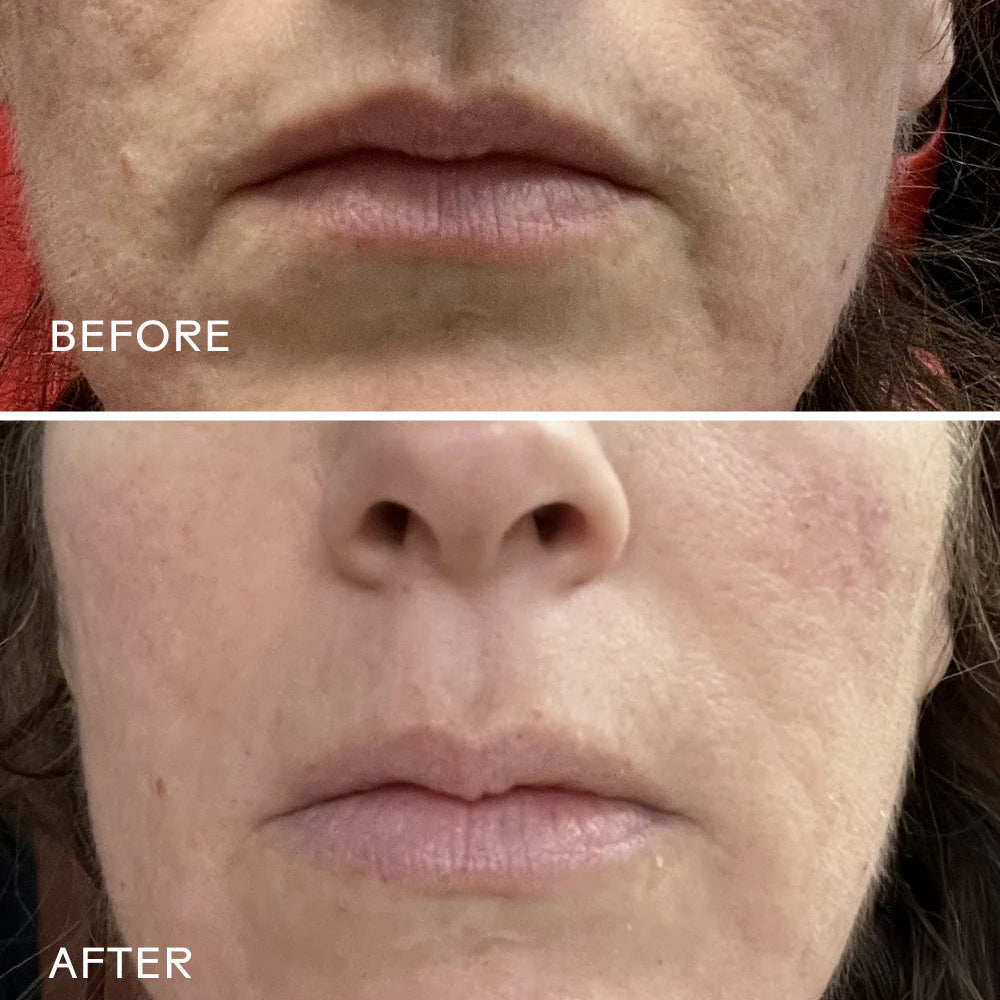 Before and after comparison of a person's face with visible skin texture changes.