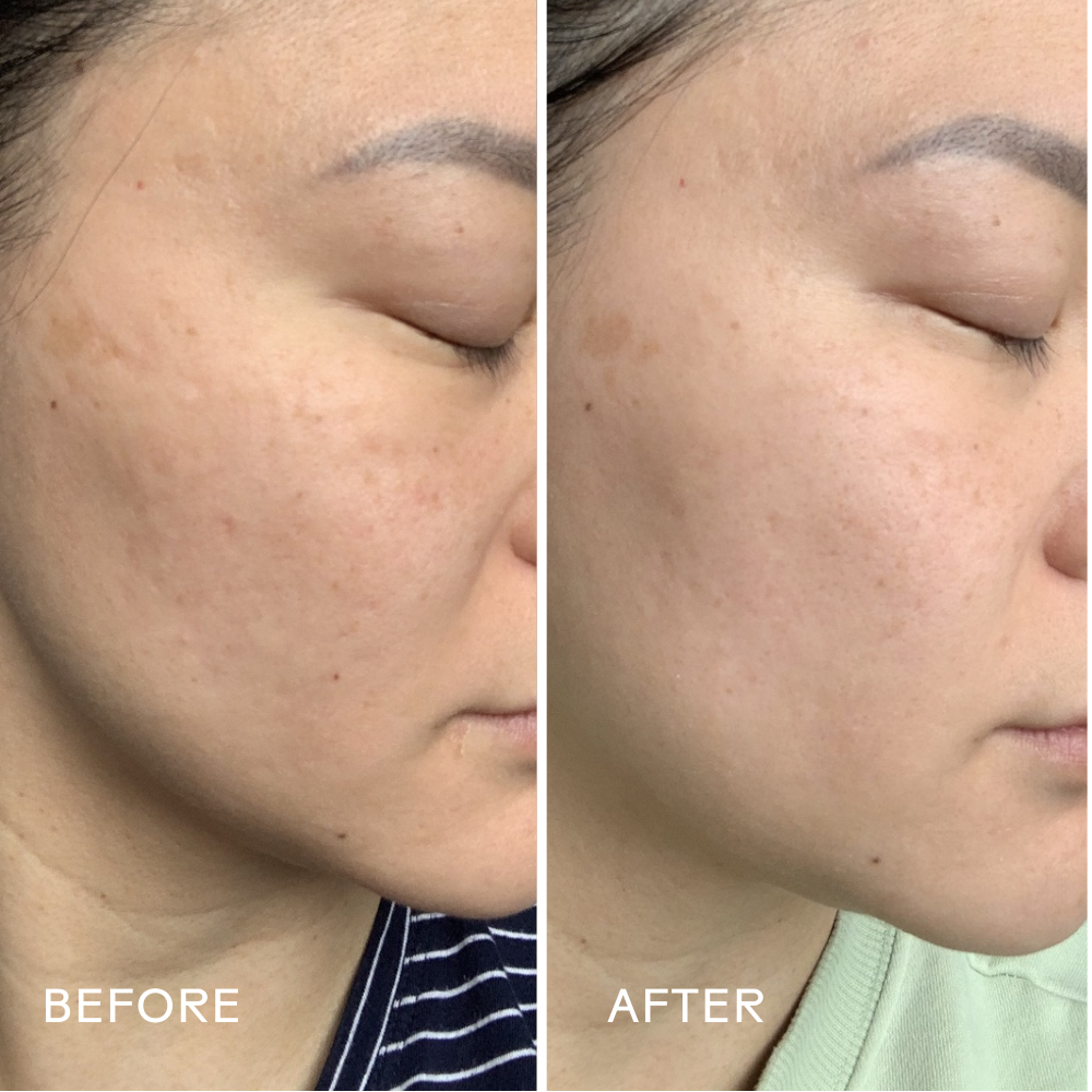 Before and after comparison of a person's face with visible skin texture changes.