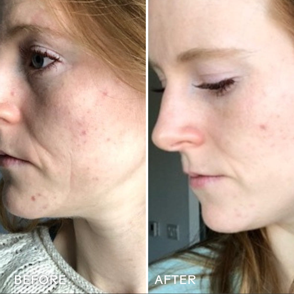 Before and after comparison of a woman's face with visible acne on the left and clearer skin on the right.