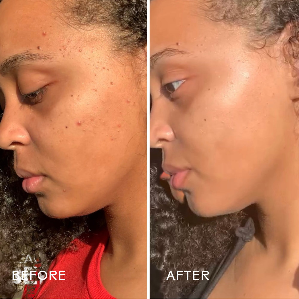 Before and after comparison of a person's face with visible skin texture changes.