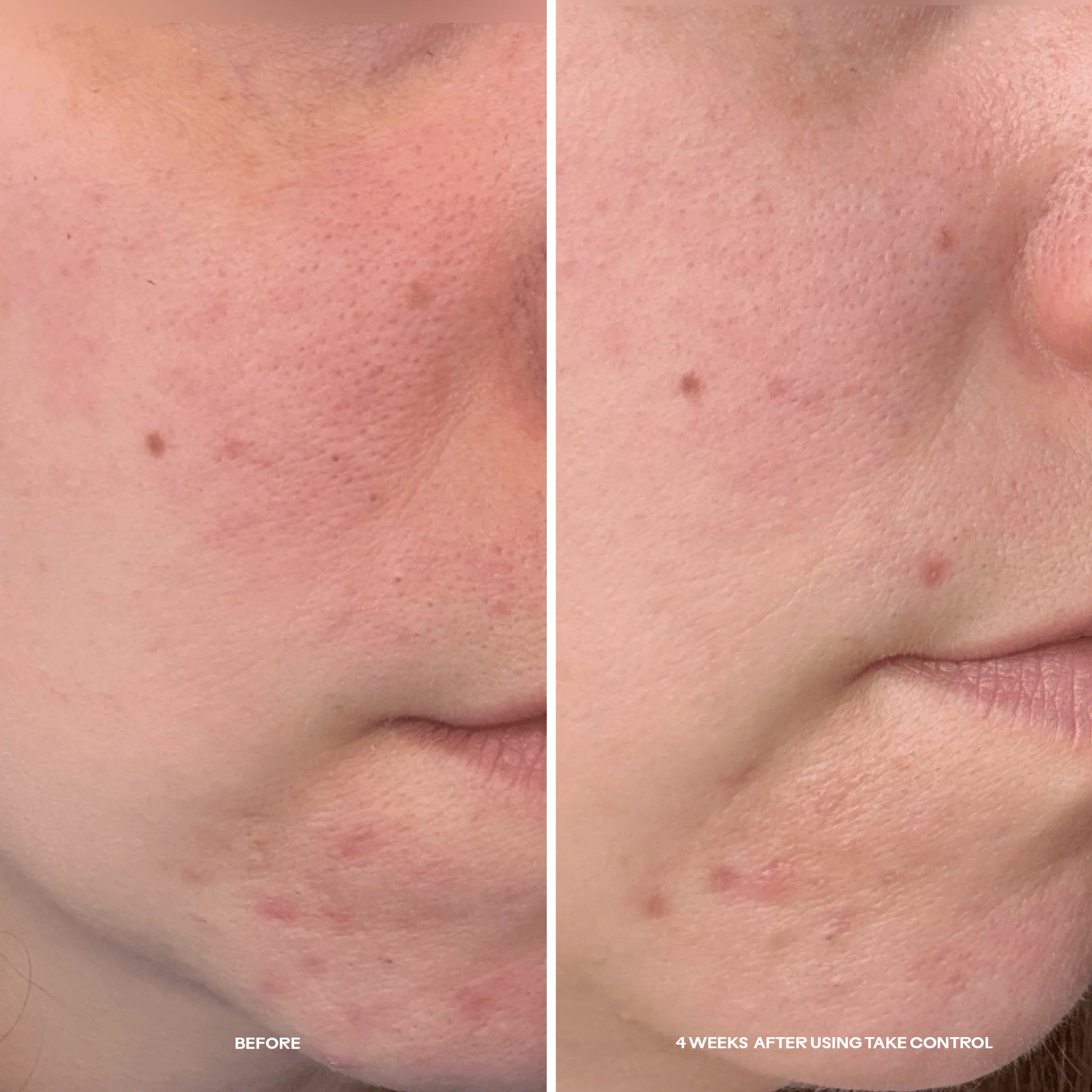 A side-by-side before-and-after comparison of a person's lower face, showing acne and skin redness on the left panel labeled 'BEFORE' and clearer skin on the right panel labeled '4 WEEKS AFTER USING TAKE CONTROL'.