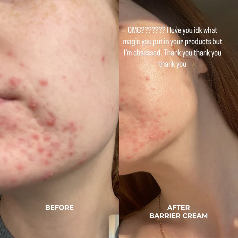 Before and after comparison of a person's face with acne, using barrier cream, and text expressing gratitude.