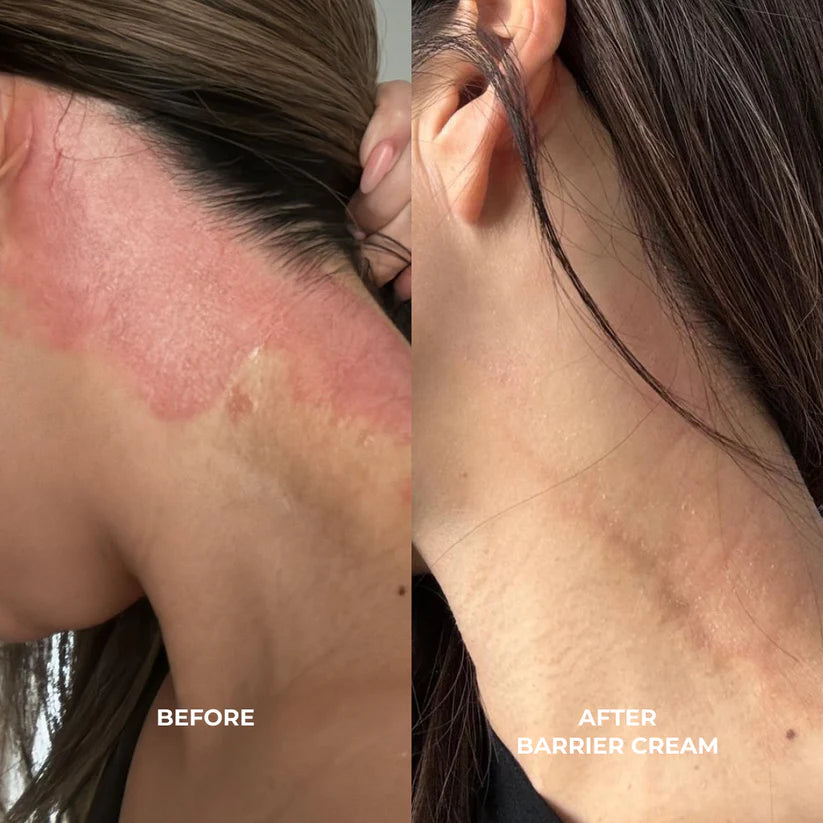 Before and after comparison of skin with barrier cream application