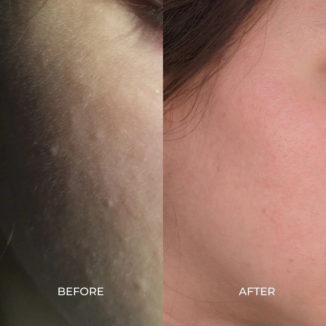 Before and after comparison of skin texture on a person's face.