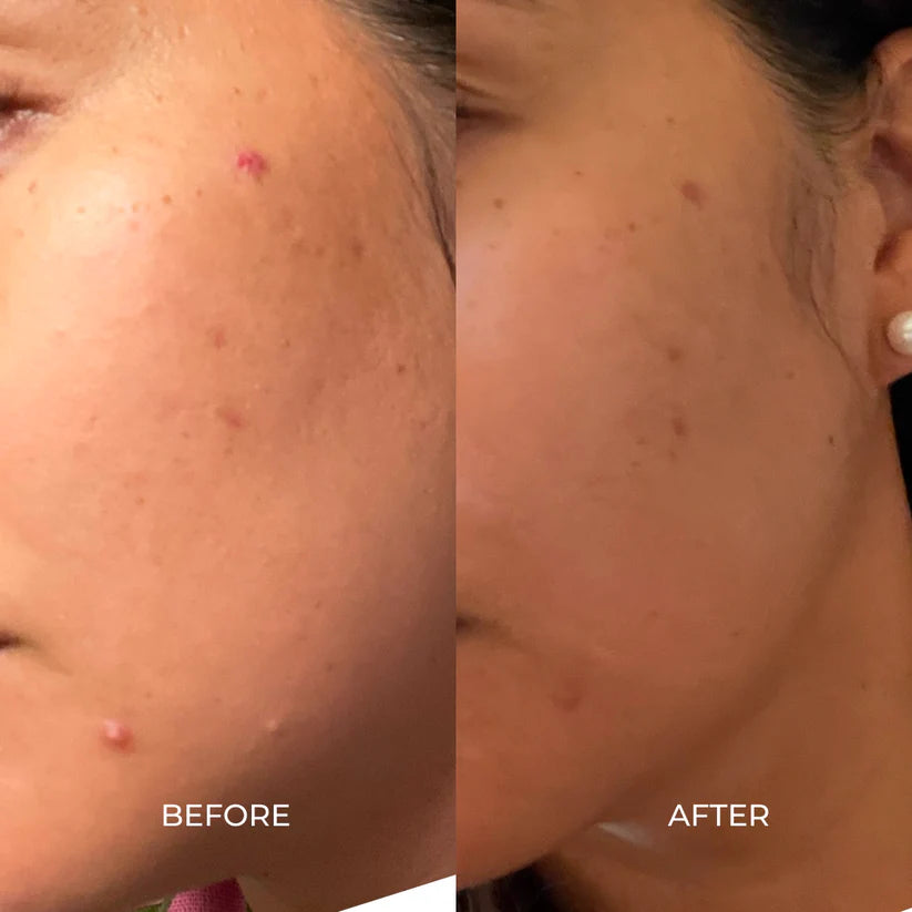 Before and after comparison of skin treatment on a person's face.